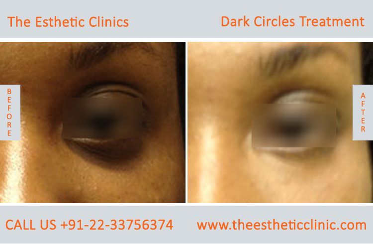 Under Eye Dark Circle Removal Laser Treatment before after photos in mumbai india (4)
